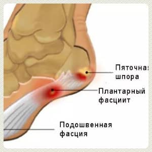 Лечебная гимнастика при пяточной шпоре