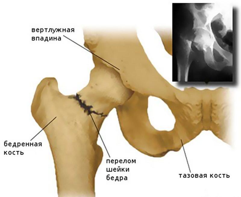 Как лечить перелом бедра