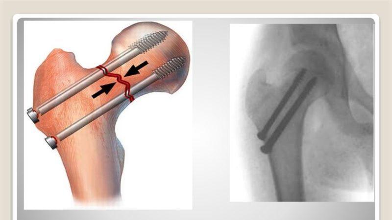 Как лечить перелом бедра