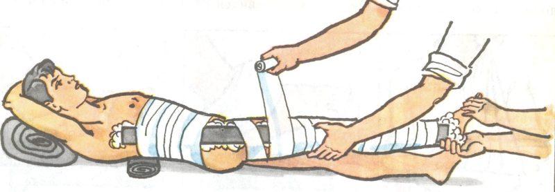 Как лечить перелом бедра