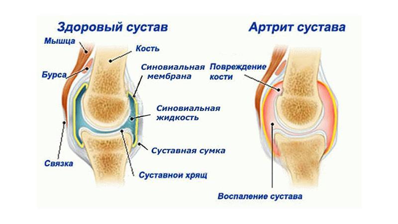 Как лечить артрит ног