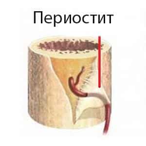 Как лечить ушиб голени
