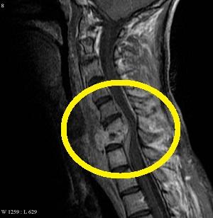 Как лечить эпидурит позвоночника