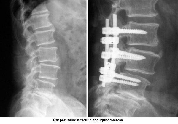 Что такое спондилолистез и как его лечить