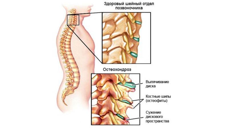 Помогает ли йога при остеохондрозе