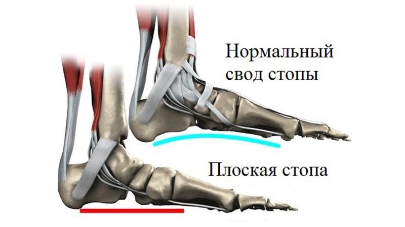 Как лечить продольное плоскостопие