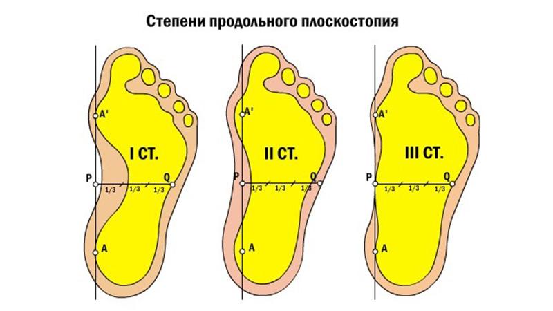 Как лечить продольное плоскостопие