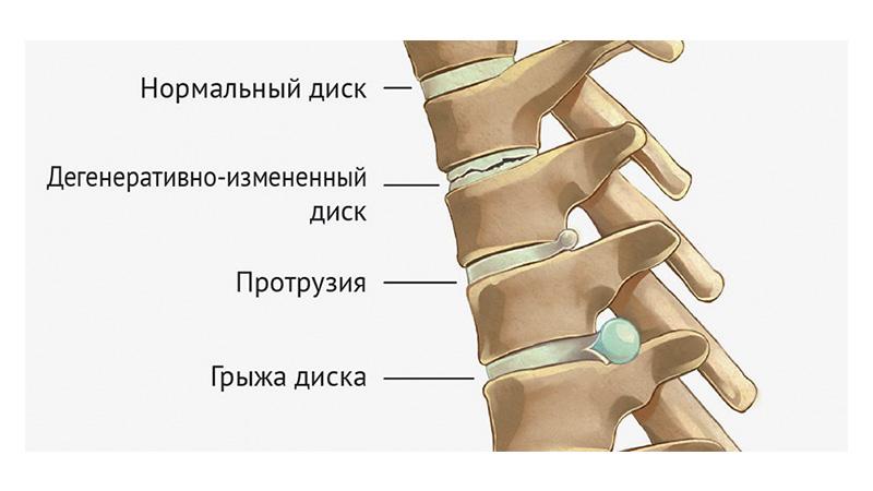 Что такое дискогенная радикулопатия