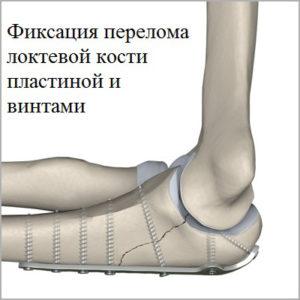 Как лечить перелом локтевого сустава