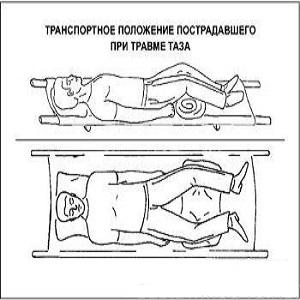 Как лечить перелом таза