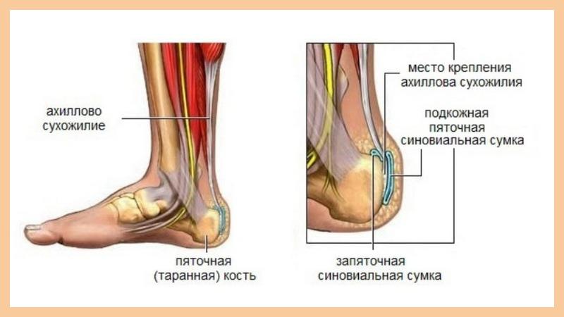 Как лечить ахиллобурсит