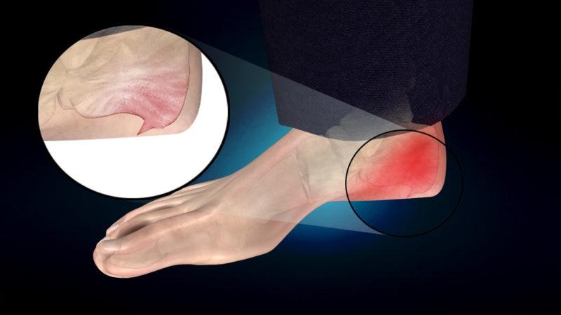 Как лечат пяточные шпоры рентгеновскими лучами