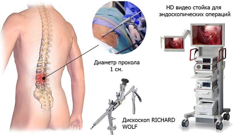 Как делают эндоскопическое удаление грыжи позвоночника