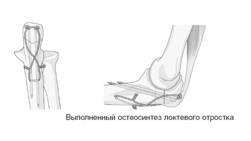 Как делают операцию остеосинтеза