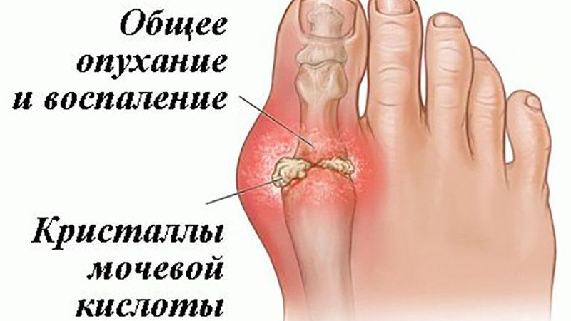 Как принимать Аспирин для лечения суставов и при подагре