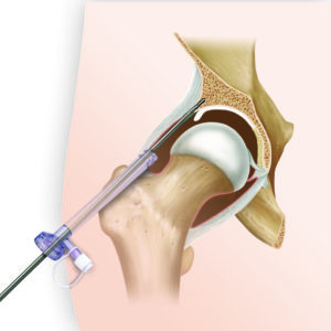Что делать при ушибе тазобедренного сустава