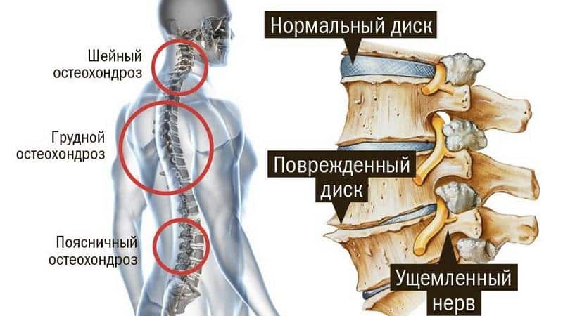 Какие упражнения делать при остеохондрозе шейного отдела