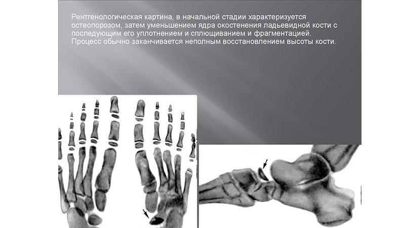 Как лечить остеохондропатию стопы