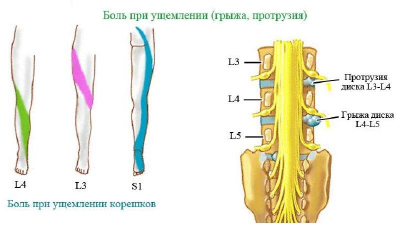 Как лечить грыжу диска L4 L5
