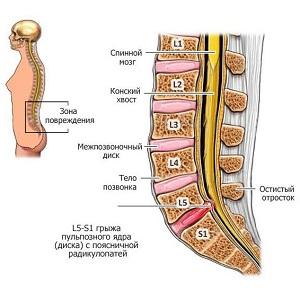 Как лечить грыжу диска L4 L5