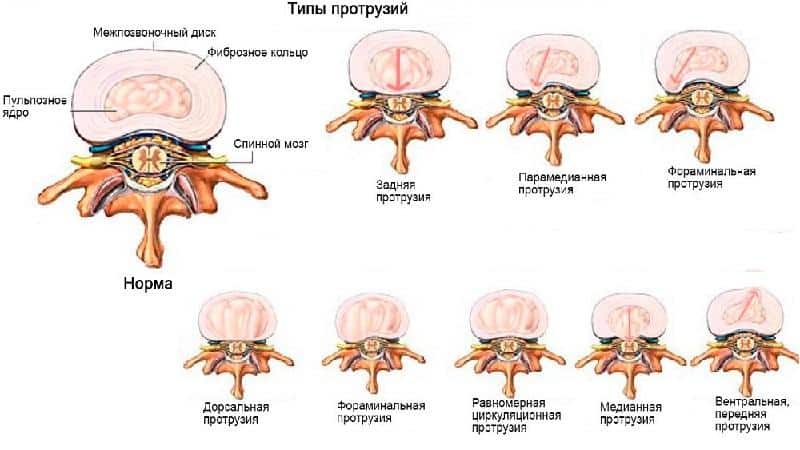 Как лечить грыжу диска L4 L5
