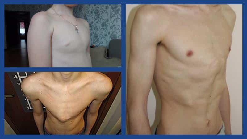 Как лечат килевидную деформацию грудной клетки