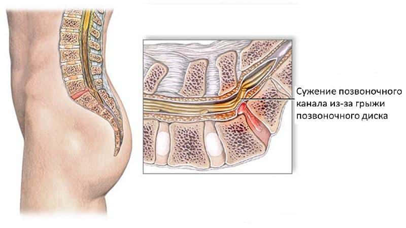Как лечить стеноз позвоночного канала поясничного отдела