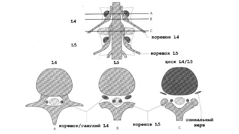 Как лечить стеноз позвоночного канала поясничного отдела