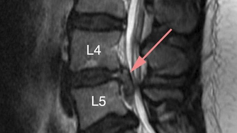 Как лечить стеноз позвоночного канала поясничного отдела