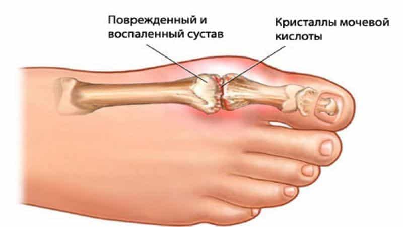 Как лечить отложение солей в стопе