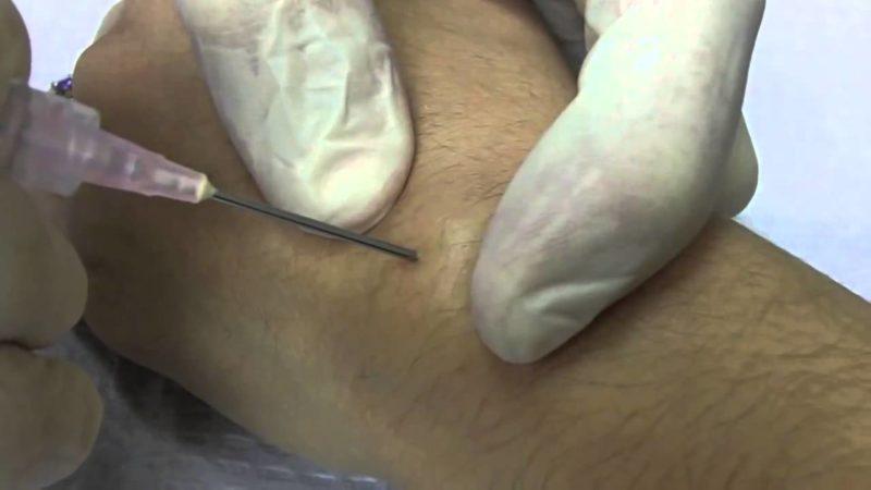 Как лечить гигрому стопы