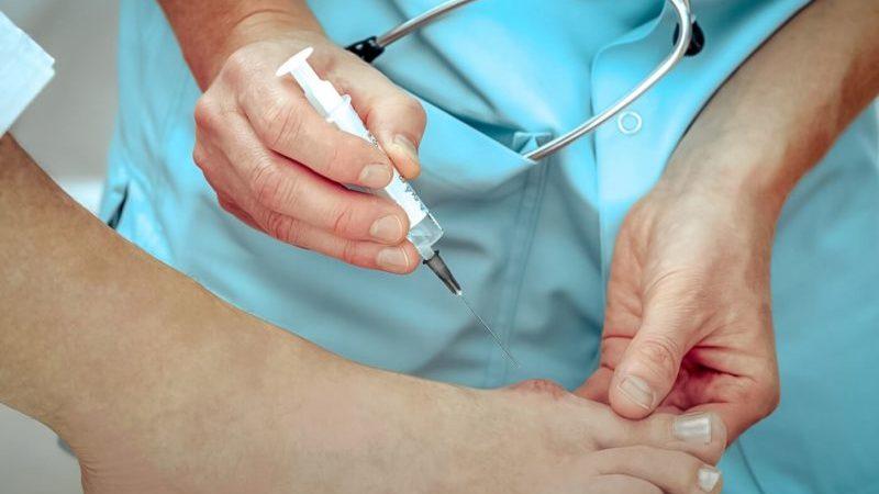 Как лечить гигрому стопы