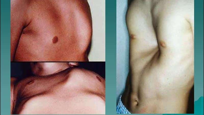 Что такое болезнь рахит