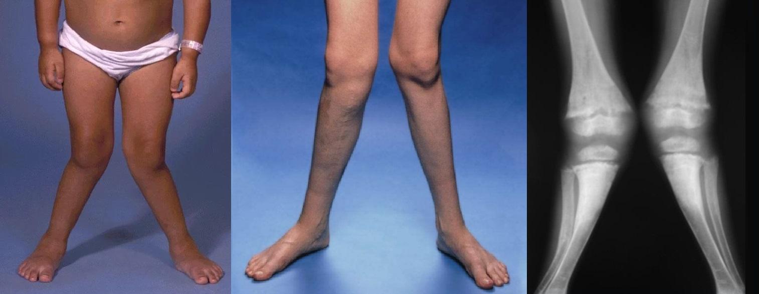 Что такое болезнь рахит