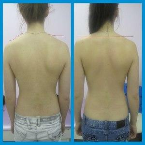 Какие упражнения можно выполнять для исправления сколиоза