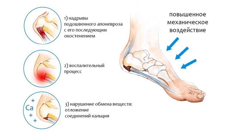 Что делать когда болит пятка и больно наступать