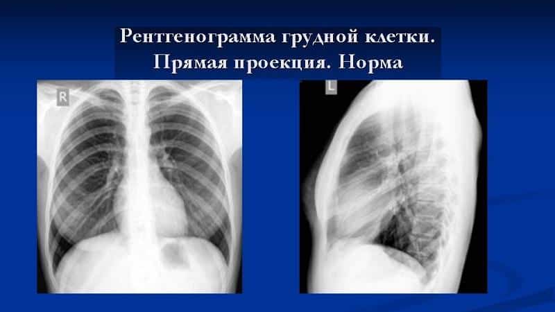 Что показывает рентген грудной клетки