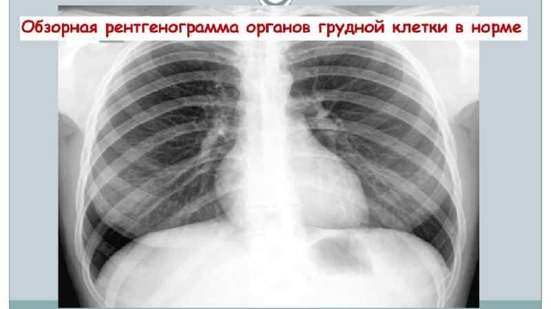 Что показывает рентген грудной клетки