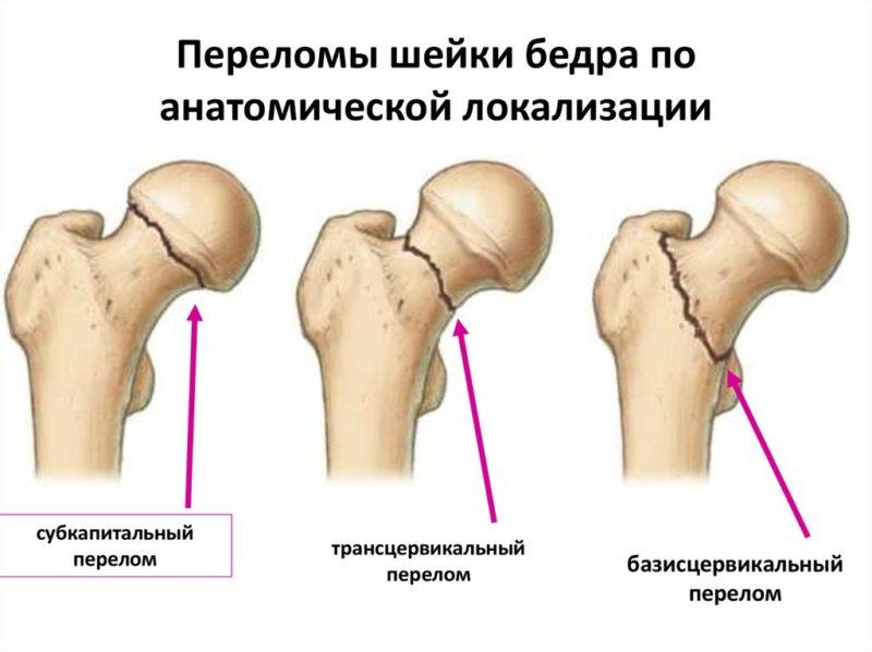 Как лечить перелом шейки бедра