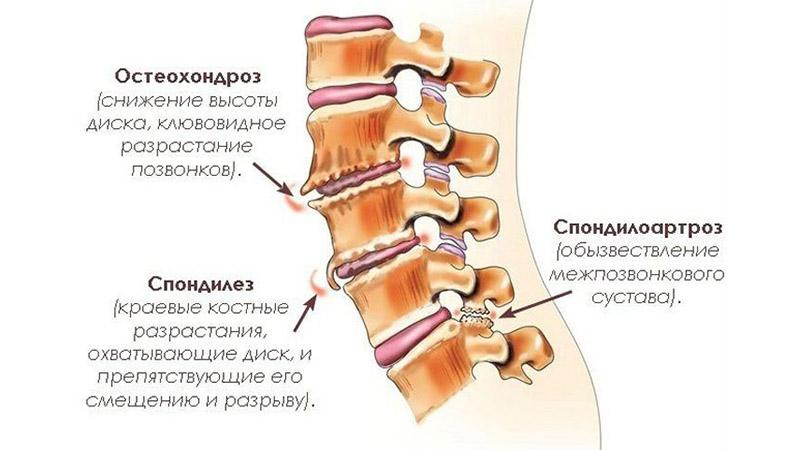 Что делать, когда болит поясница при наклонах и сидении