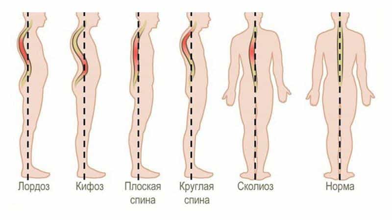 Как исправить осанку