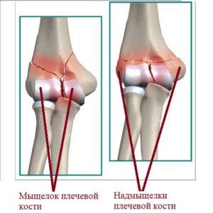 Перелом надмыщелка плечевой кости