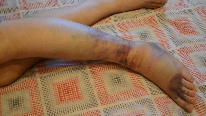 Что делать при вывихе голеностопного сустава