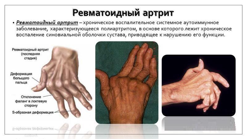 Что такое артрит и как его лечить