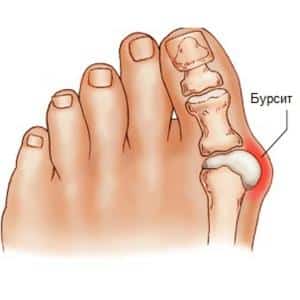 Что такое бурсит и как его лечить