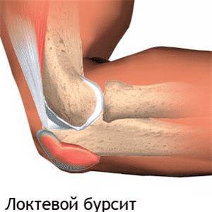 Что такое бурсит и как его лечить