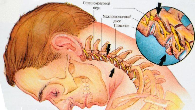 Что такое дискоз позвоночника и как его лечить