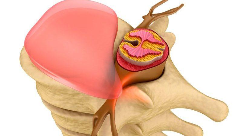 Что такое дискоз позвоночника и как его лечить