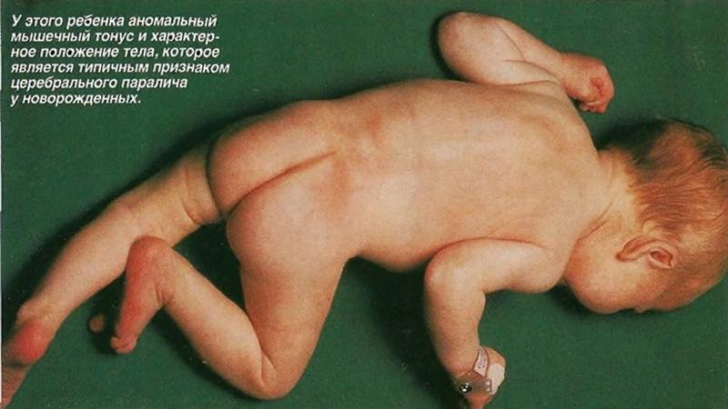 Что такое гемипарез и как его лечат