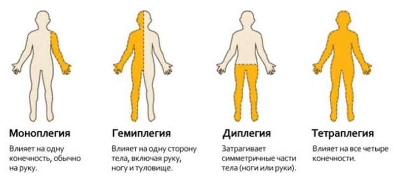Что такое гемипарез и как его лечат